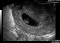 Fetus development 6 week 6 day